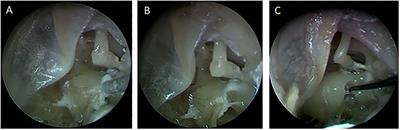 Fusion of Technology in Cochlear Implantation Surgery: Investigation of Fluoroscopically Assisted Robotic Electrode Insertion